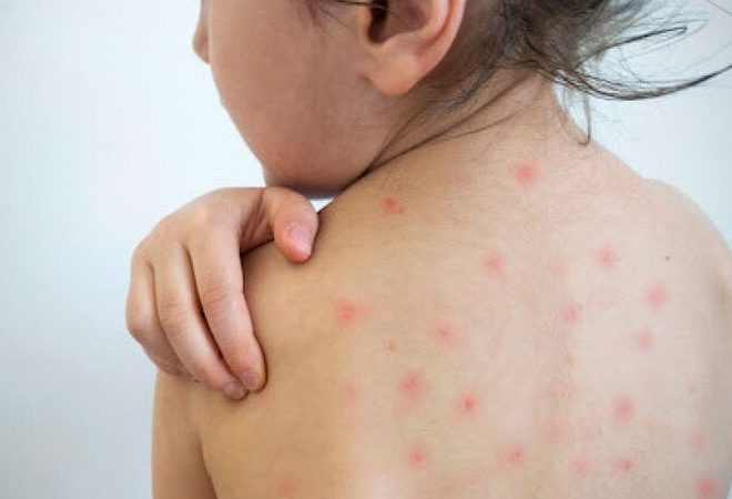 Azərbaycanda qızılca və suçiçəyinə yoluxanların sayı açıqlandı