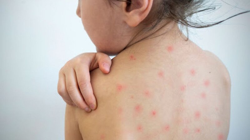 Azərbaycanda qızılca və suçiçəyinə yoluxanların sayı açıqlandı